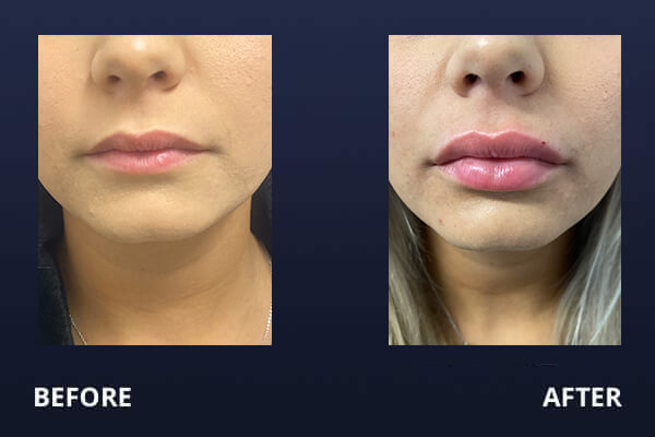 Juvederm Before and After Pictures